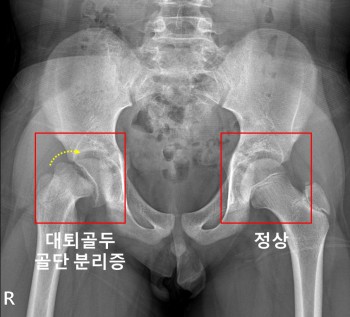 우측 고관절에 대퇴골두 골단 분리증 및 무혈성 괴사가 발생한 소아청소년 환자의 X-ray
