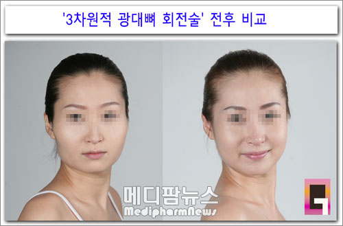 서양인보다 커 보이는 한국인 얼굴 광대뼈원인